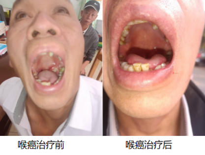 尿毒症乳腺癌 不讲价钱凭良心给广西百色杨忠雅